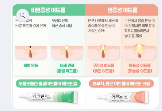 Acnon cream - PURULENT ACNE, RED ACNE TREATMENT CREAM 13g 애크논 크림